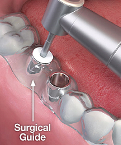 Scaling and Polishing