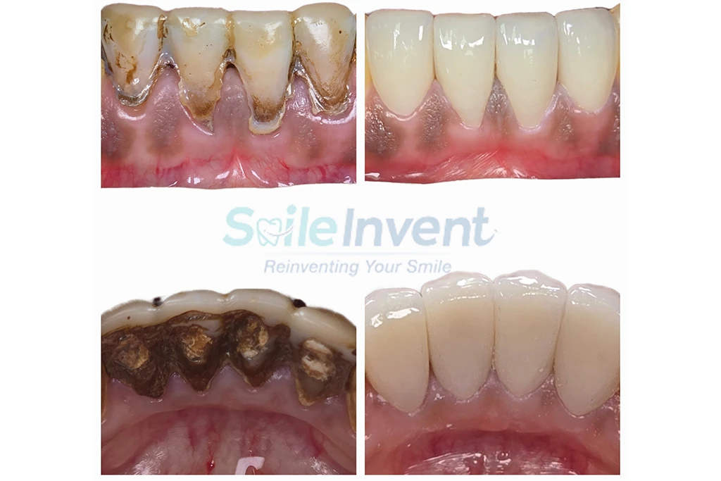 Before and after dental treatment at Smile Invent Dental Clinic, Bandra East