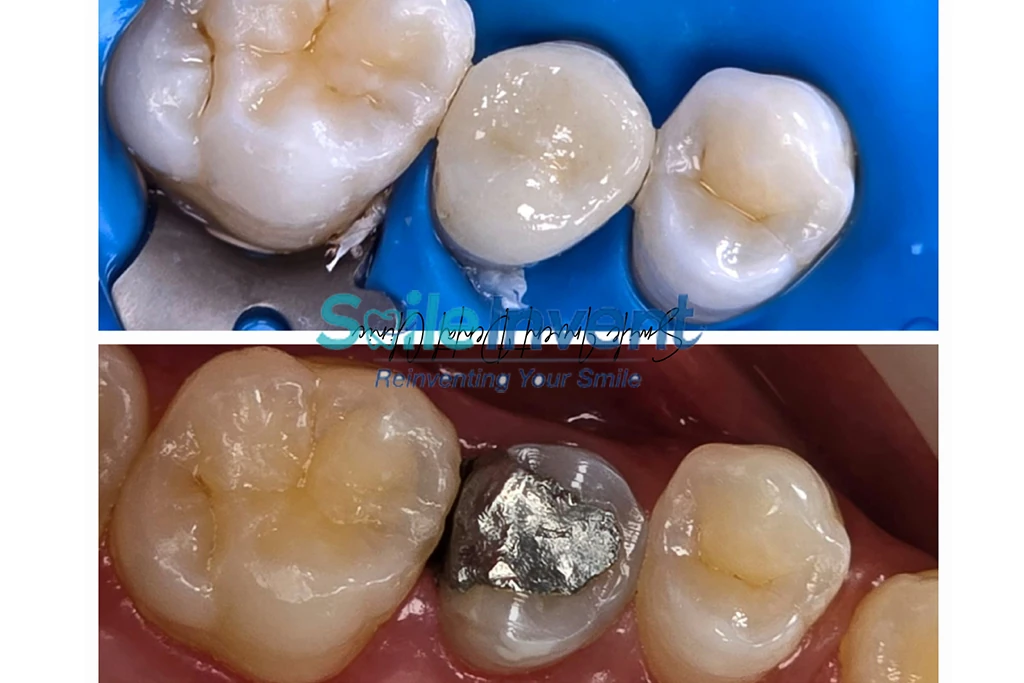 Before and after dental treatment at Smile Invent Dental Clinic, Bandra East