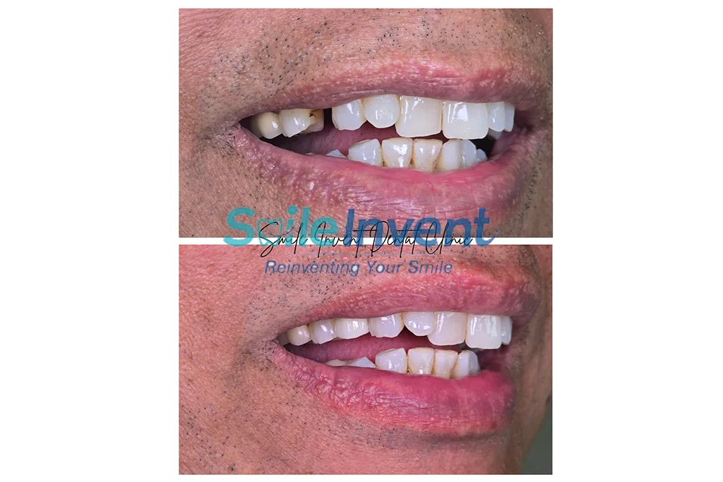 Before and after dental treatment at Smile Invent Dental Clinic, Bandra East