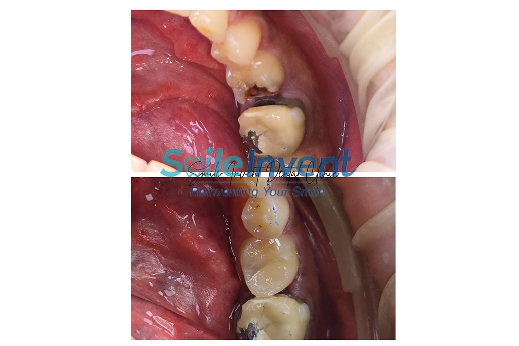 Before and after dental treatment at Smile Invent Dental Clinic, Bandra East