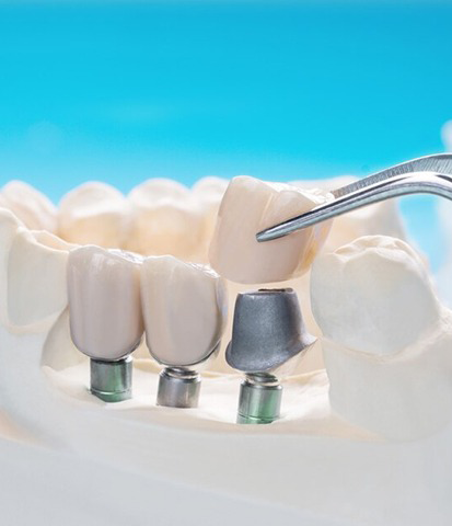 Restorative Dentistry