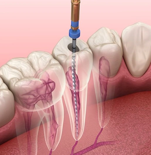 Root Canal