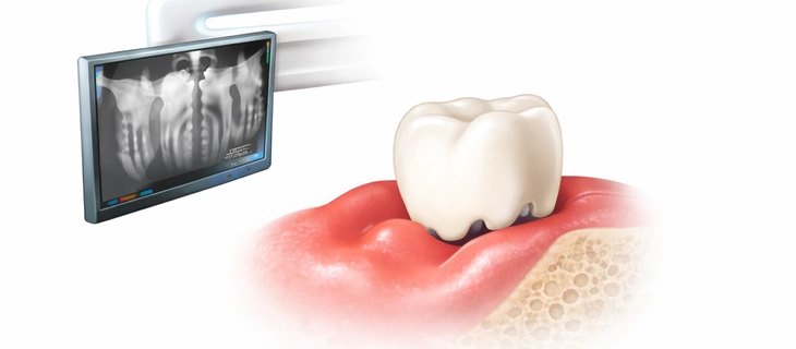 Root Canal