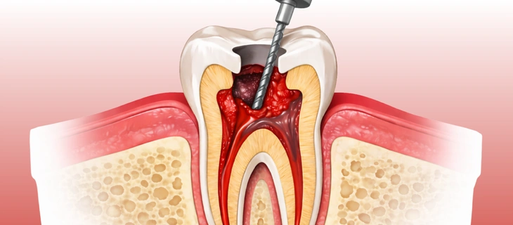 Root Canal
