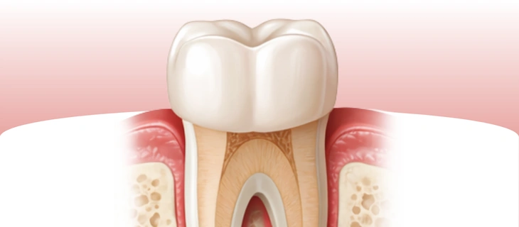 Root Canal