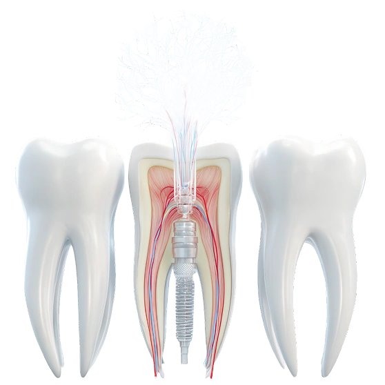 Root Canal
