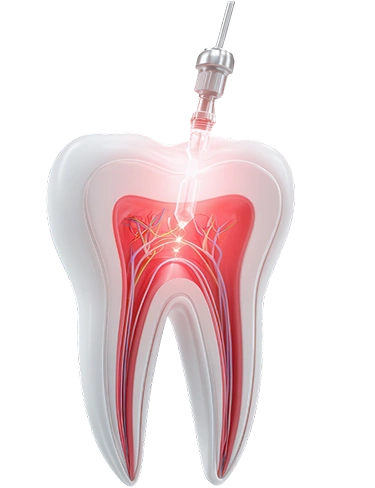 Root Canal