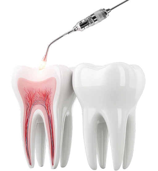 Root Canal