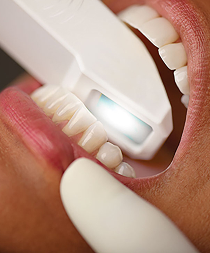 Scaling and Polishing