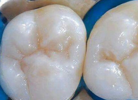 Dental Fillings