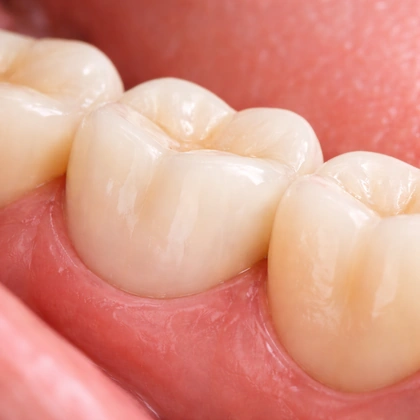 all-Ceramic-zirconia-crowns