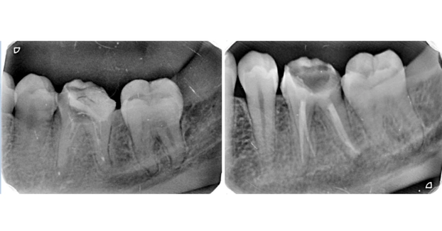 Root Canal