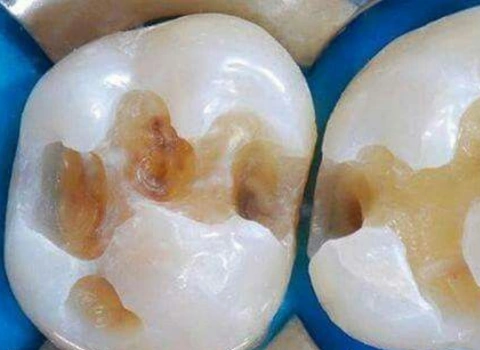 Dental Fillings
