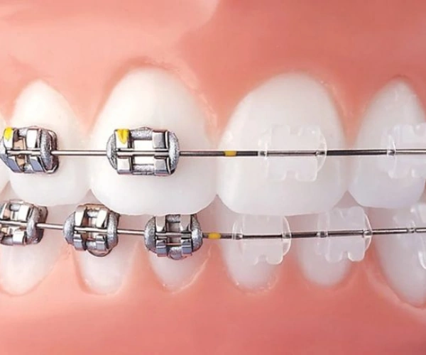 Benefits of Dental Braces