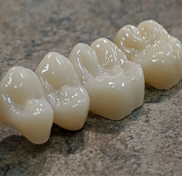 Benefits of Dental Bridges
