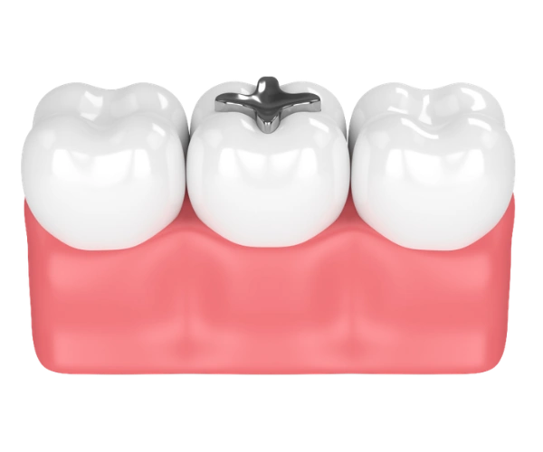 Dental Fillings