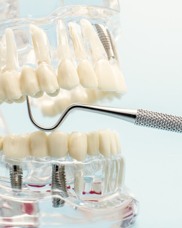 Scaling and Root Planing