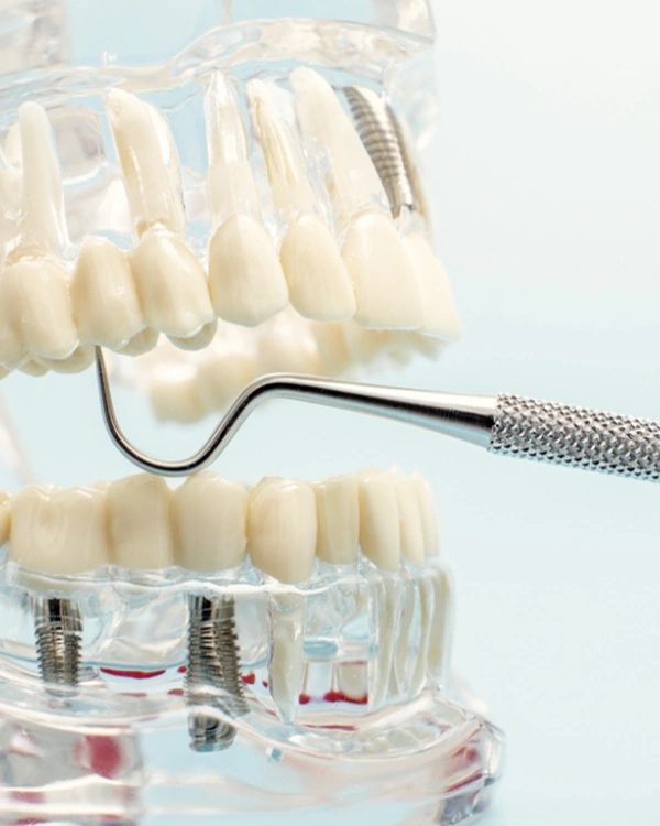 Dental Implants