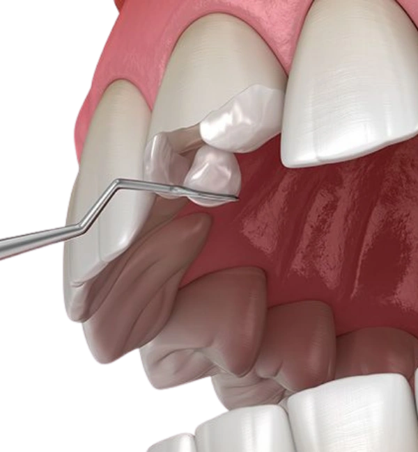 Dental Bonding