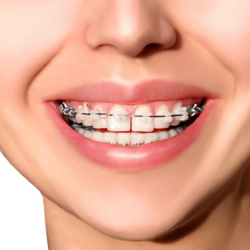 Ceramic Braces