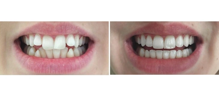 Clear Aligners