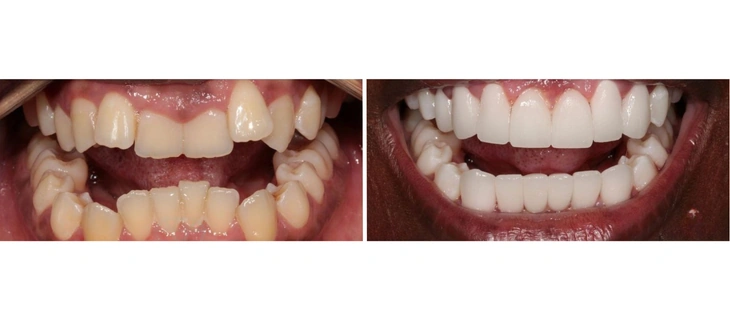 Clear Aligners
