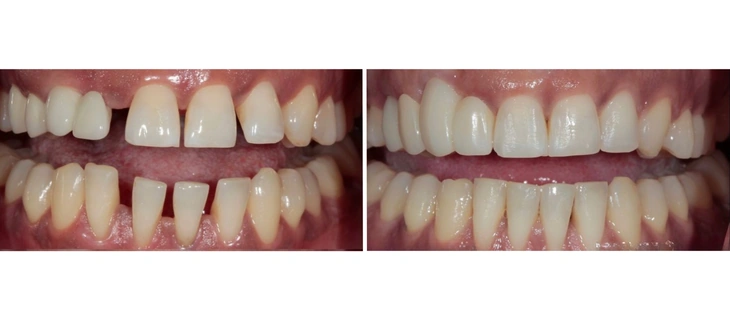 Clear Aligners