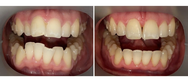 Clear Aligners