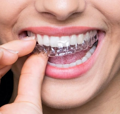 FULL MOUTH DENTAL IMPLANTS