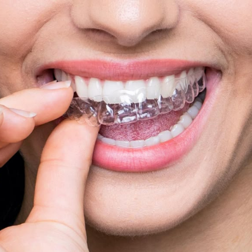 Clear Aligners