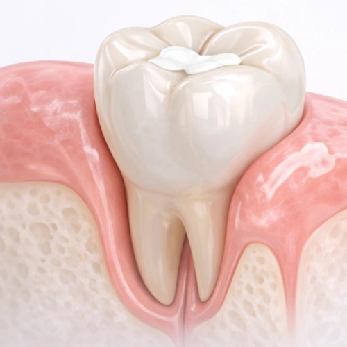 Composite Filling