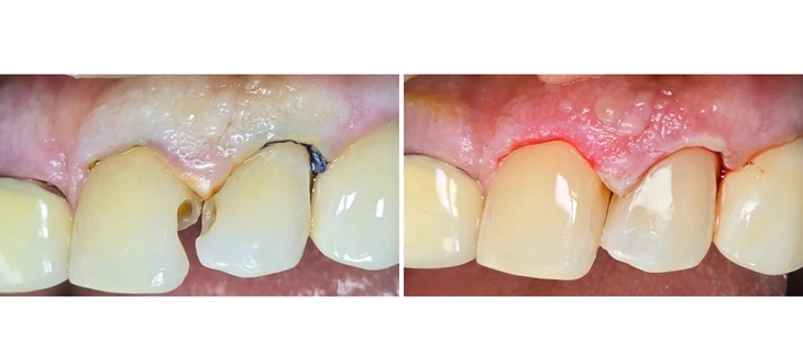 Dental Fillings