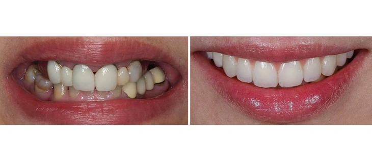 Dental Fillings