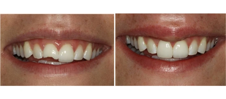 Dental Fillings