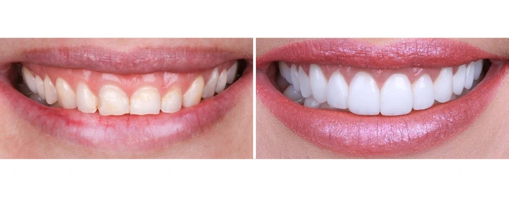 Dental Fillings