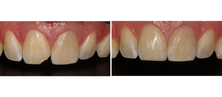 Teeth Cleaning