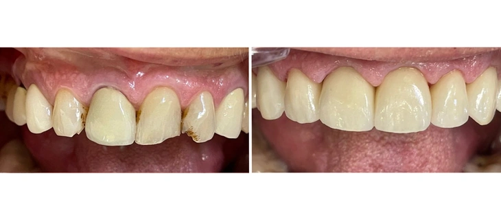 Teeth Cleaning