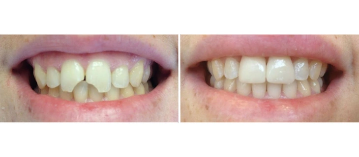 Teeth Cleaning