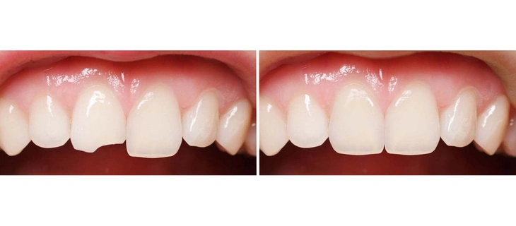 Teeth Cleaning