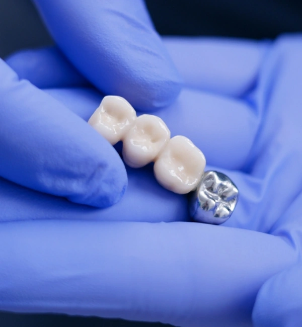 Dental Bridges