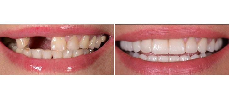 Dental Bridges