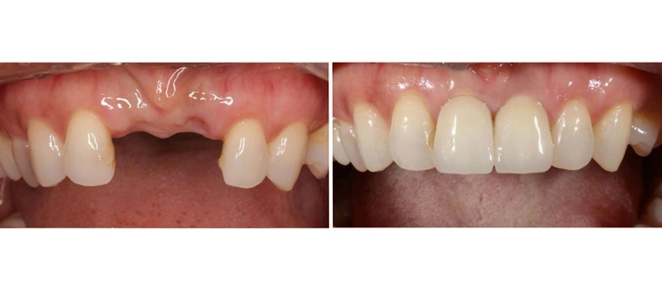 Dental Bridges