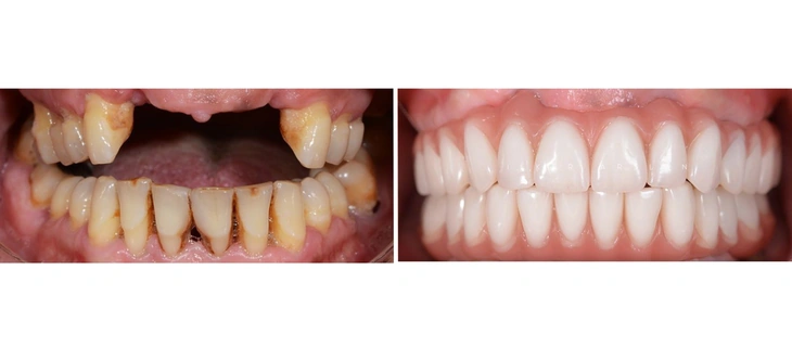 Dental Bridges