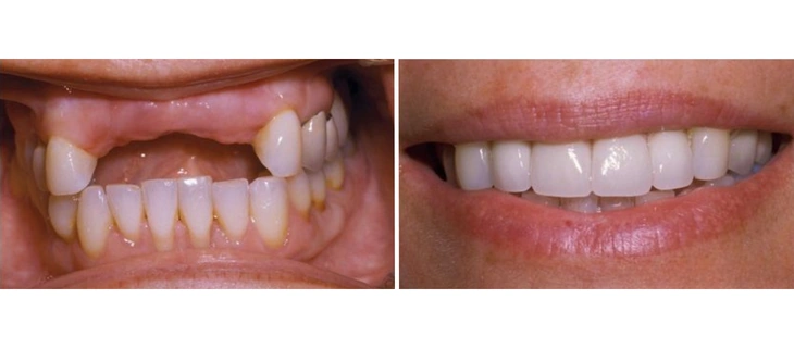 Dental Bridges