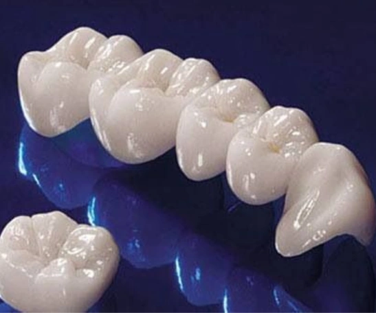 Dental Bridges