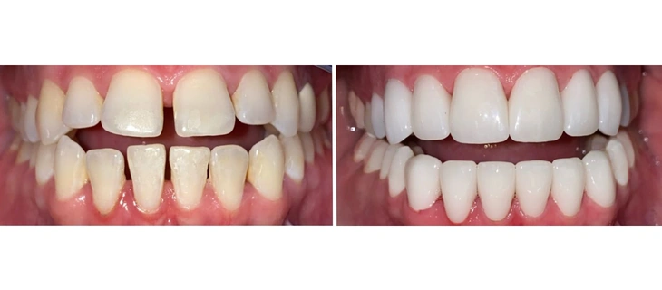 Dental Crowns