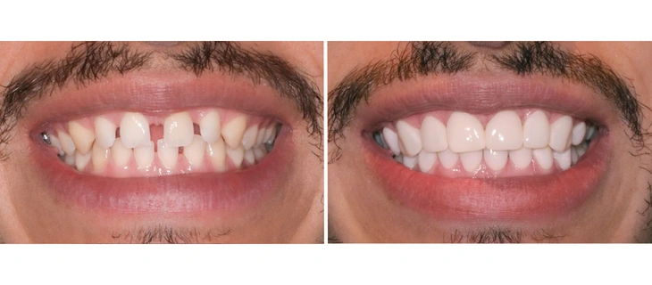 Dental Crowns