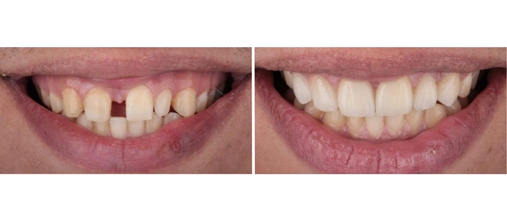 Dental Crowns