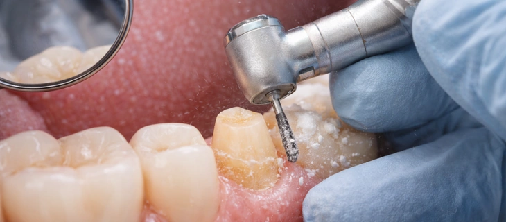 Tooth Preparation